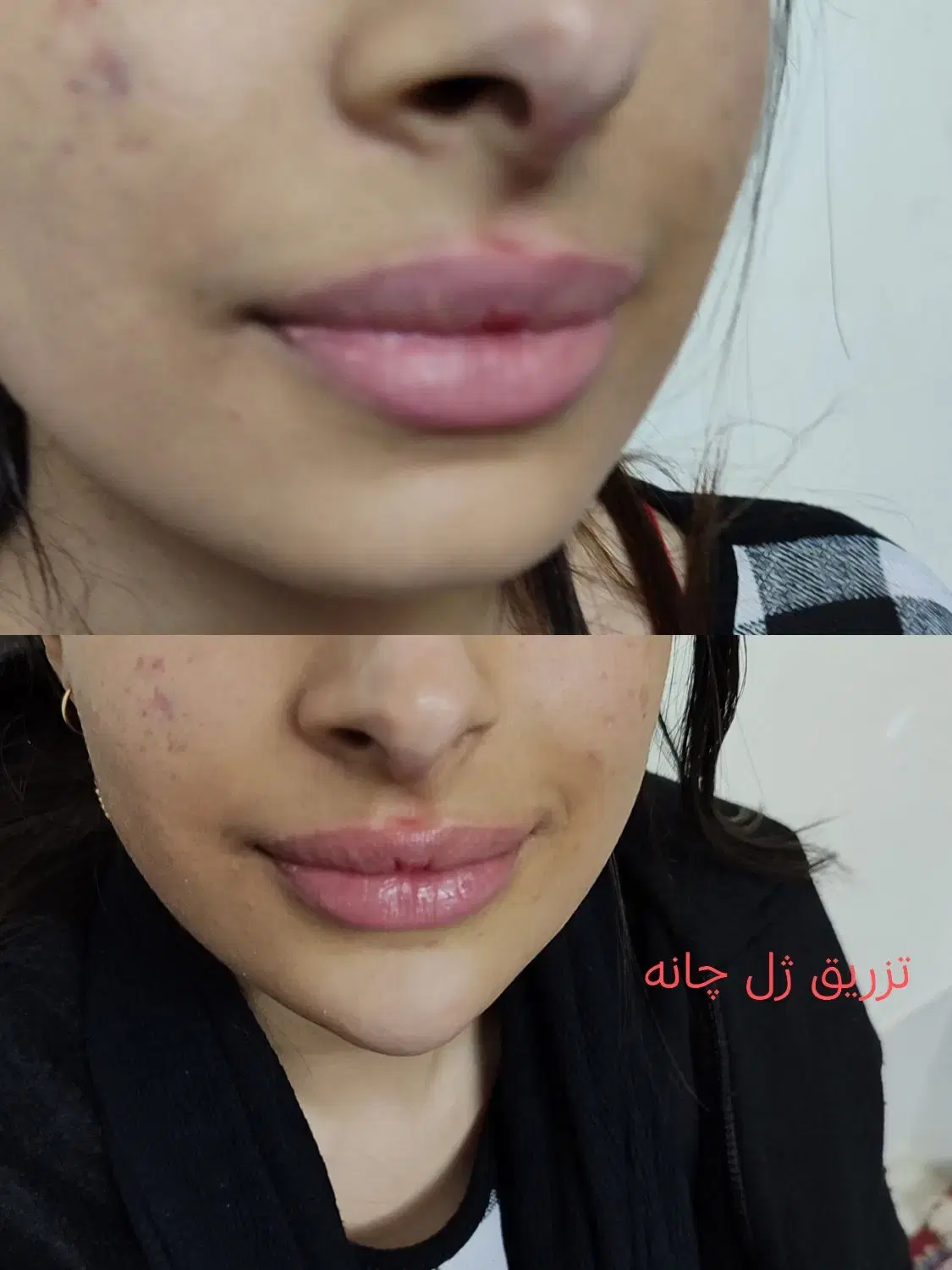 تزریق ژل بوتاکس جوانساز جهرم