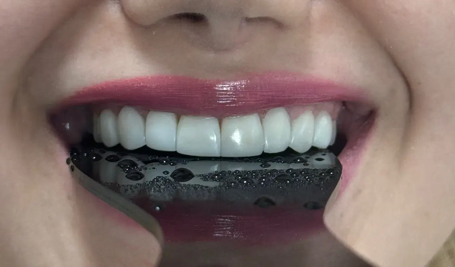 (زیبایی) ونییر کامپوزیت و لمینیت، بلیچینگ|خدمات آرایشگری و زیبایی|رشت, گلسار|دیوار