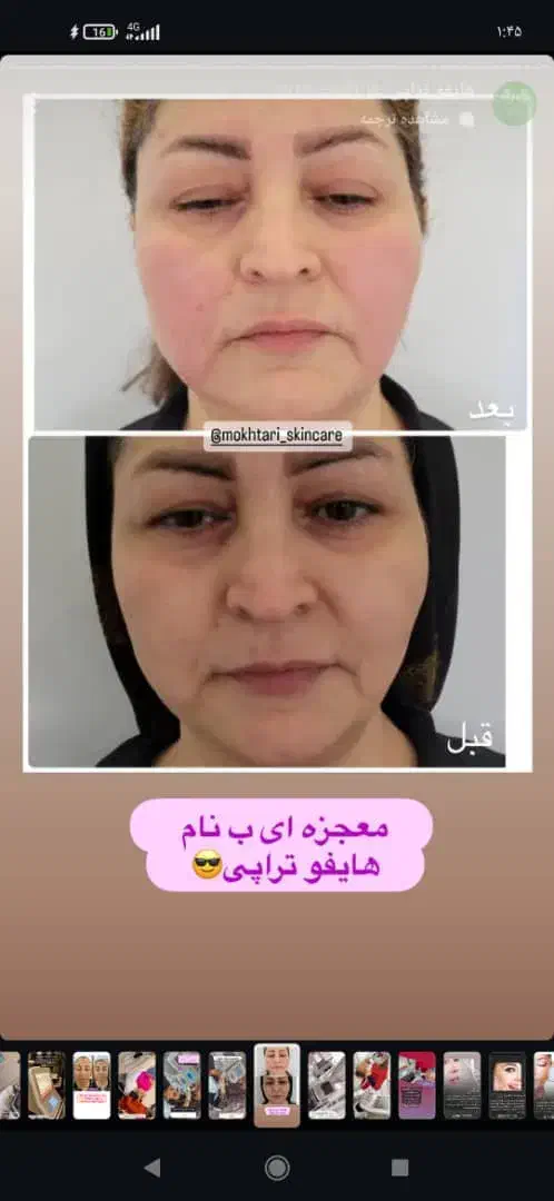 هایفوتراپی ۷بعدی تخفیف ویژه برای اولین ها|خدمات آرایشگری و زیبایی|قم, صدوق|دیوار