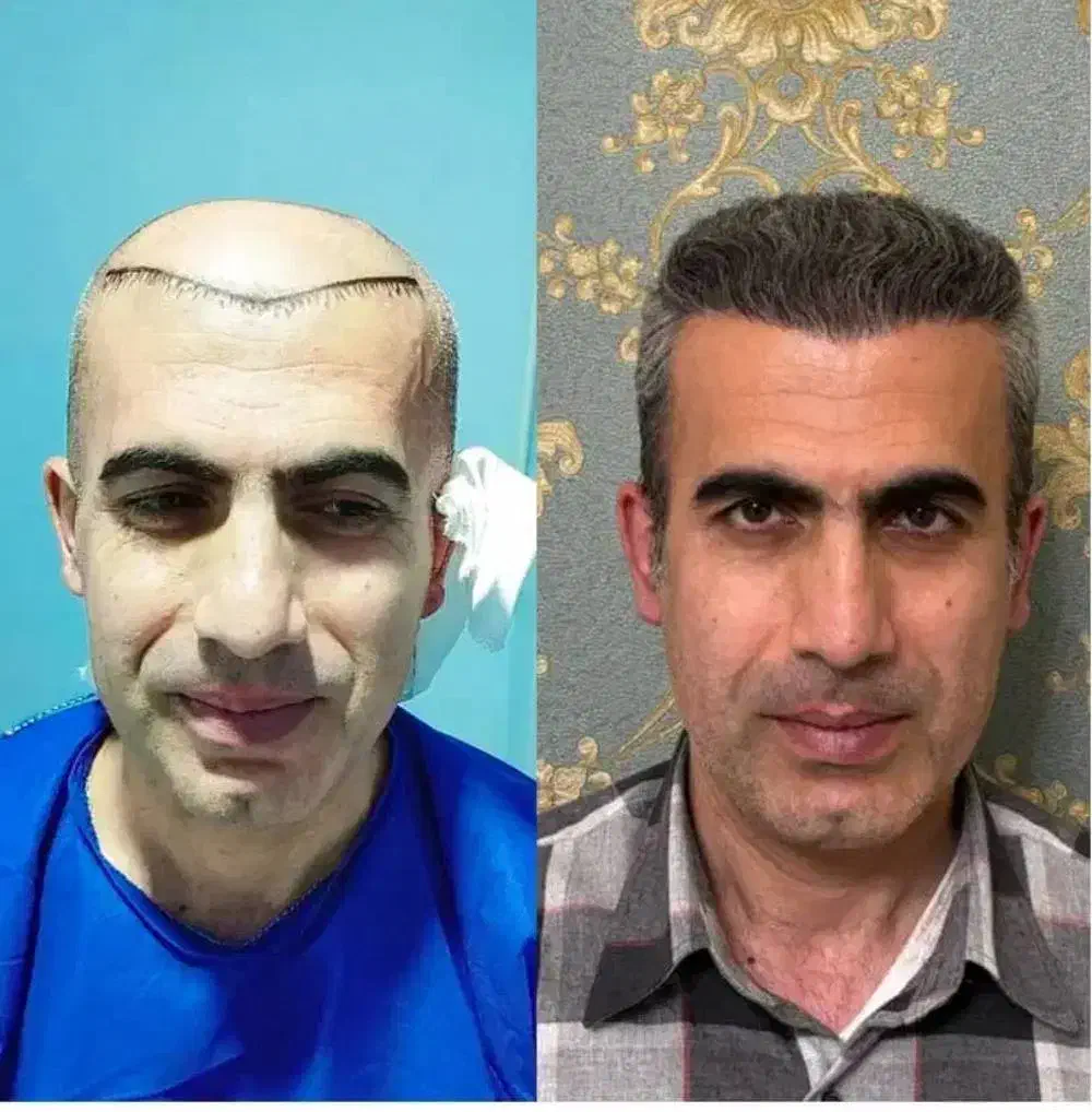 کاشت مو/کاشتمو/کاشت ریش یک مرحله ای|خدمات آرایشگری و زیبایی|نجفآباد, باغ ملی|دیوار