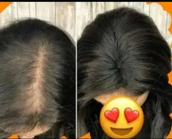 قطع مشکلات مربوط به ریزش مو|آرایشی، بهداشتی، درمانی|تهران, شهرک آزمایش|دیوار