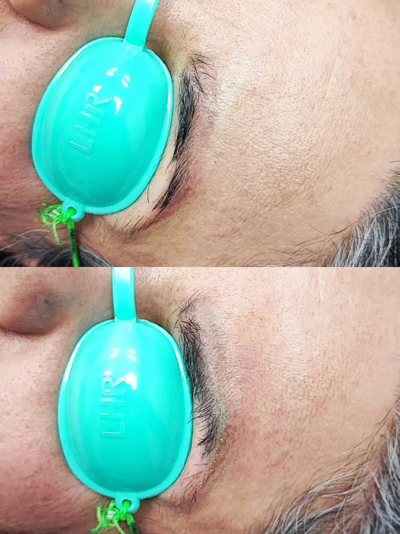 ریموو تتو و رفع تیرگی بدن در مطب پزشک|خدمات آرایشگری و زیبایی|آبادان, |دیوار