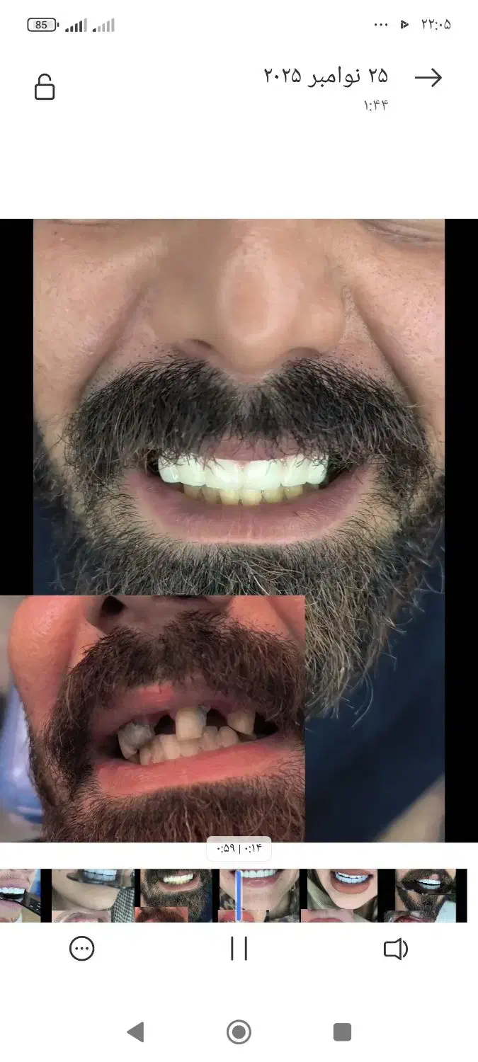 کامپوزیت دندان|خدمات آرایشگری و زیبایی|دورود, |دیوار