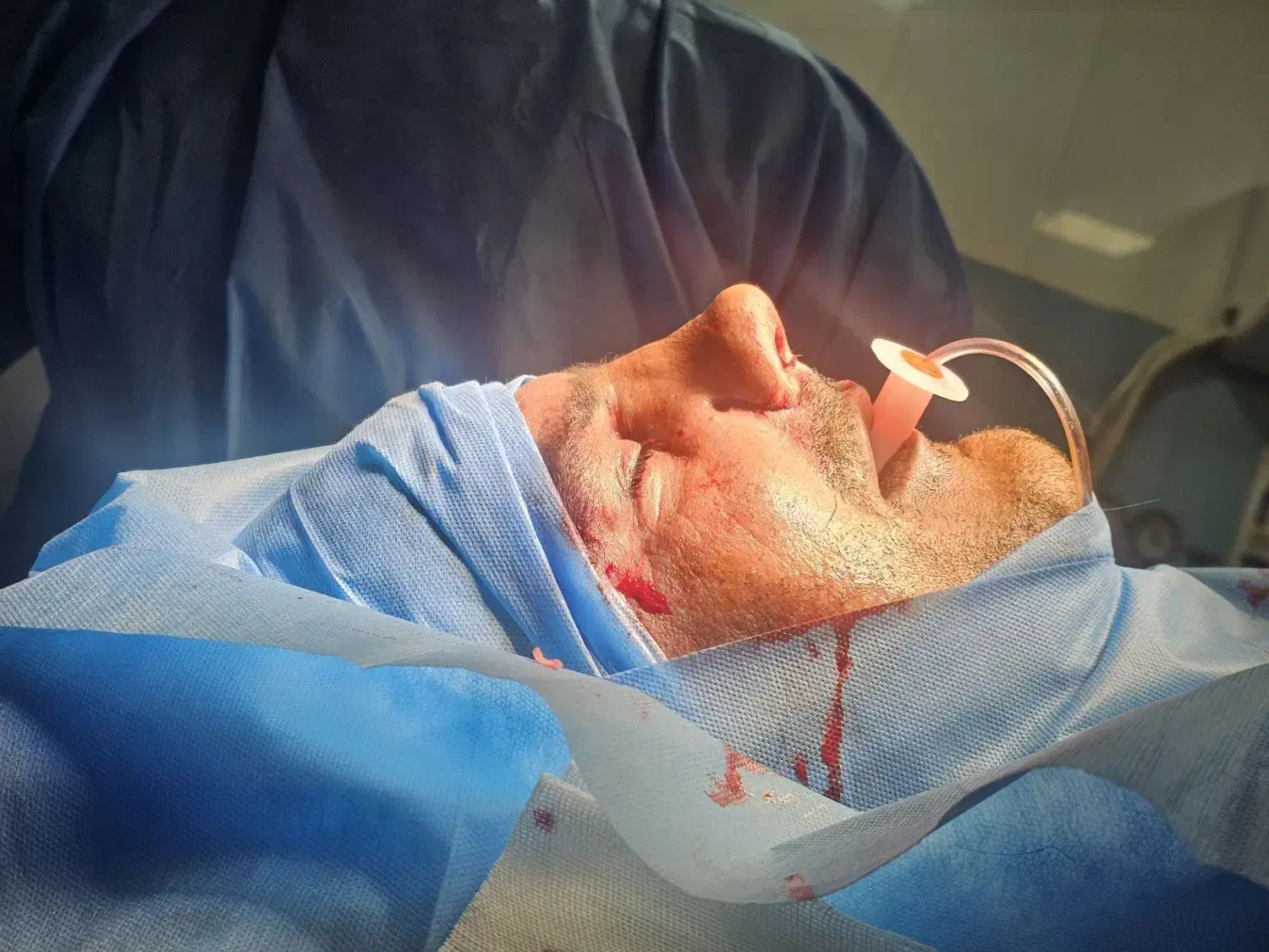 جراحی بینی توسط دکتر متخصص امیر اسدالله پور|پزشکی|قائمشهر, |دیوار