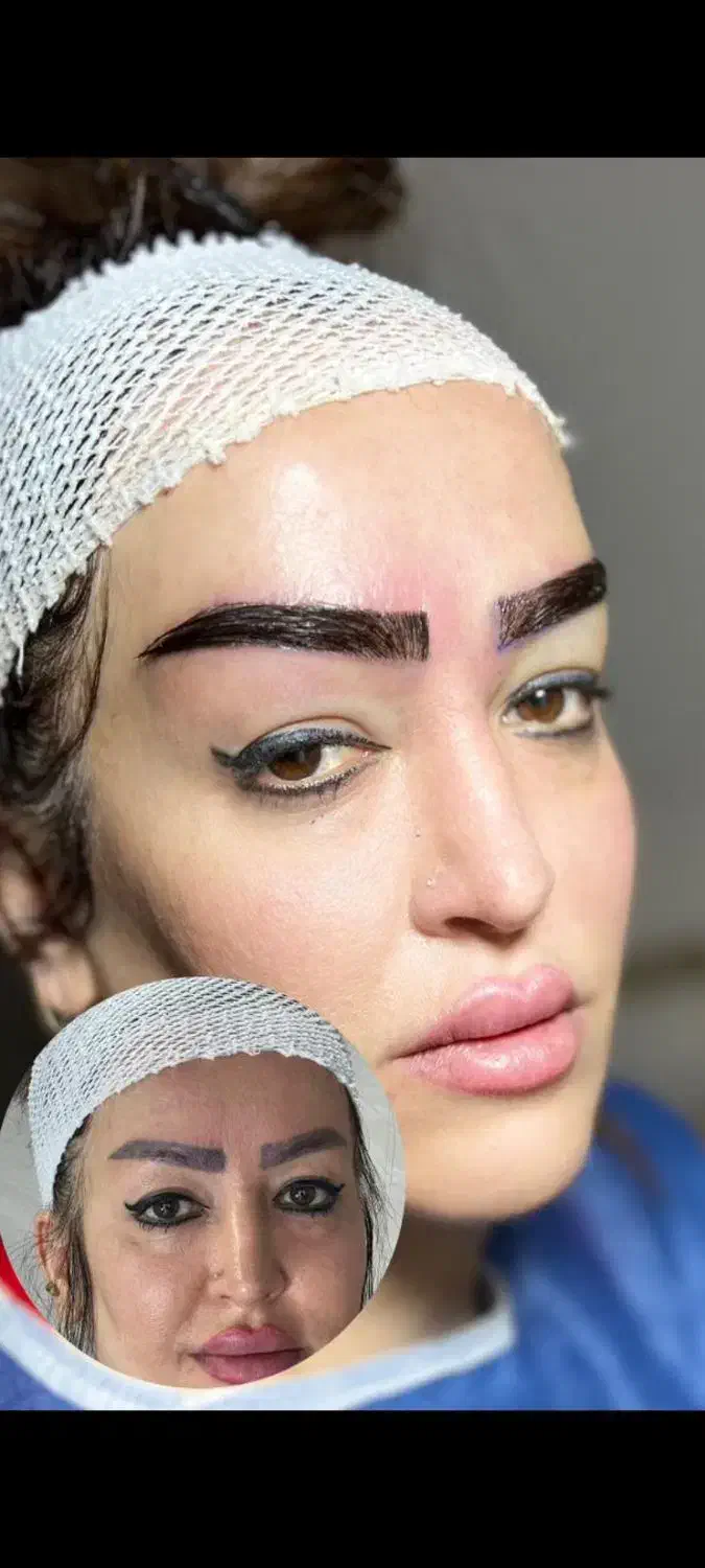 کاشت مو و ابرو|خدمات آرایشگری و زیبایی|میانه, |دیوار