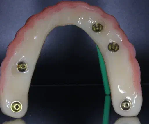 روکش تمام سرامیک ودندان مصنوعی|آرایشی، بهداشتی، درمانی|اندیمشک, |دیوار