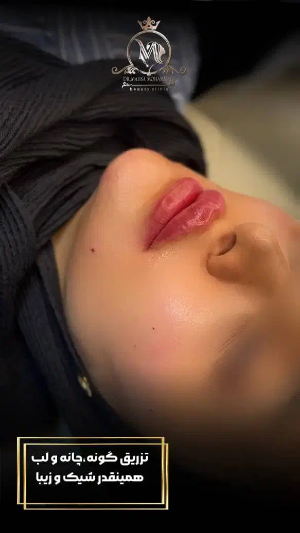 فیلر لب بوتاکس بلفاروپلاستی تخلیه غبغب مزوتراپی|خدمات آرایشگری و زیبایی|اندیشه, اندیشه فاز ۳|دیوار