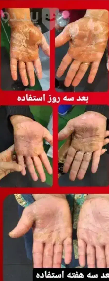 کرم درمان پسوریازیس و اگزما|آرایشی، بهداشتی، درمانی|تهران, حسین‌آباد|دیوار