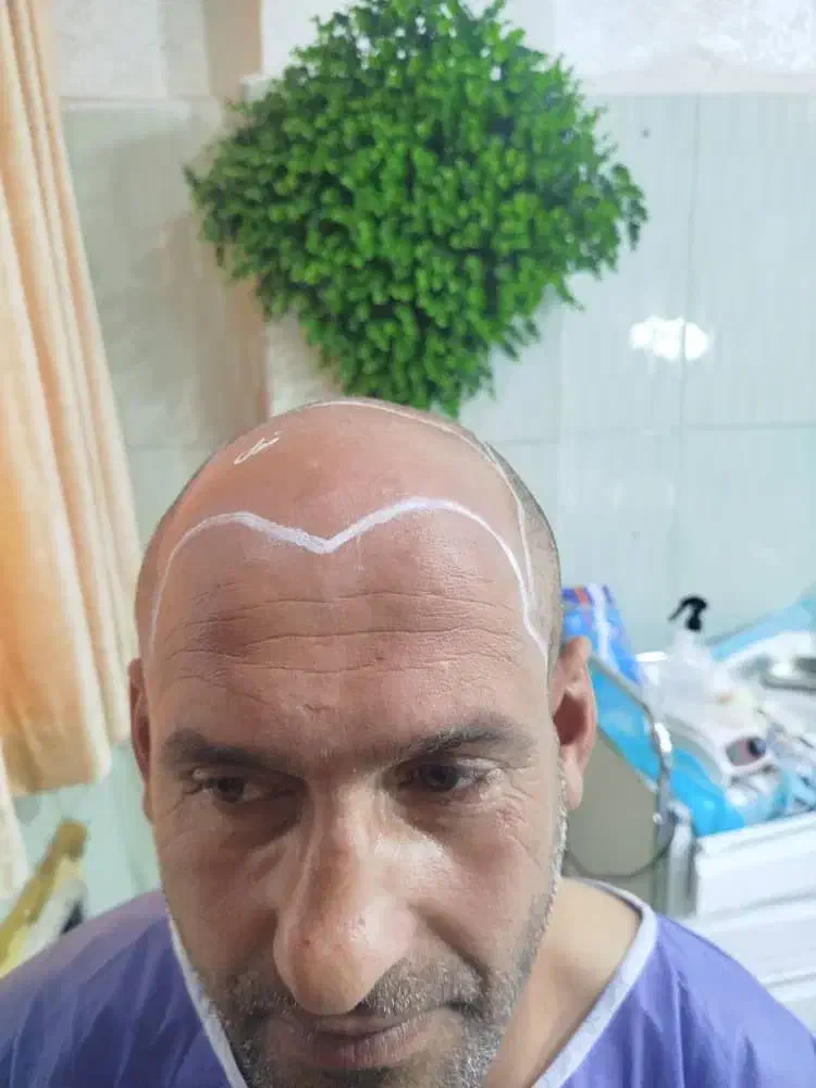 کاشت مو،ریش ،سیبیل،ابرو،پی آرپی ومزوتراپی|خدمات آرایشگری و زیبایی|بوشهر, |دیوار