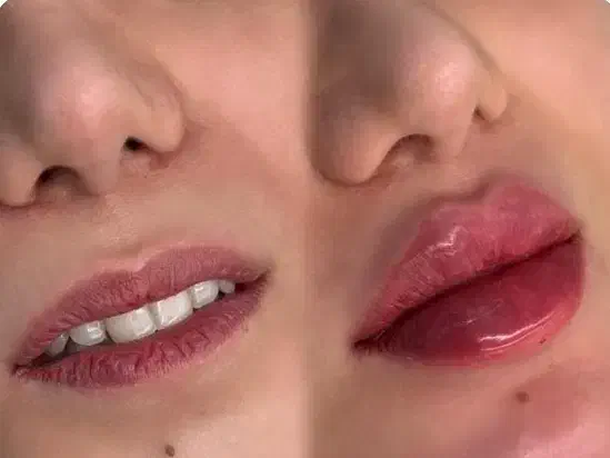 تزریق ژل وفیلرو انزیم و ساکشن فیلربادی|خدمات آرایشگری و زیبایی|کرمانشاه, |دیوار