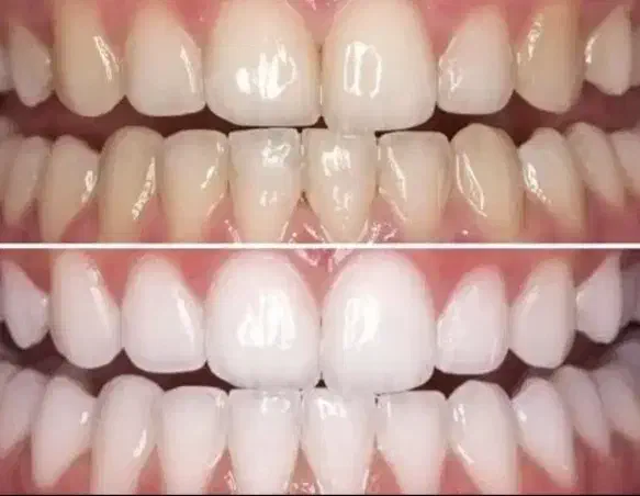 سفید کننده فوری دندان|آرایشی، بهداشتی، درمانی|زرندیه, |دیوار