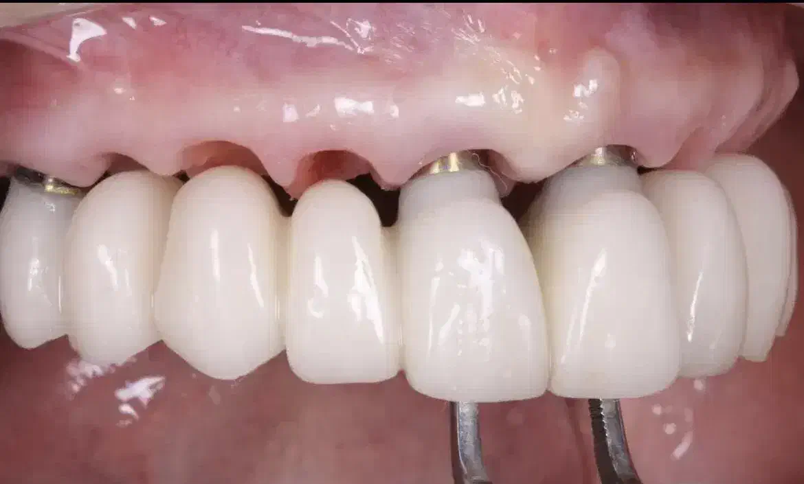 دندانپزشکی ایمپلنت و..بااقساط بلندمدت در تبریز|خدمات آرایشگری و زیبایی|مرند, |دیوار