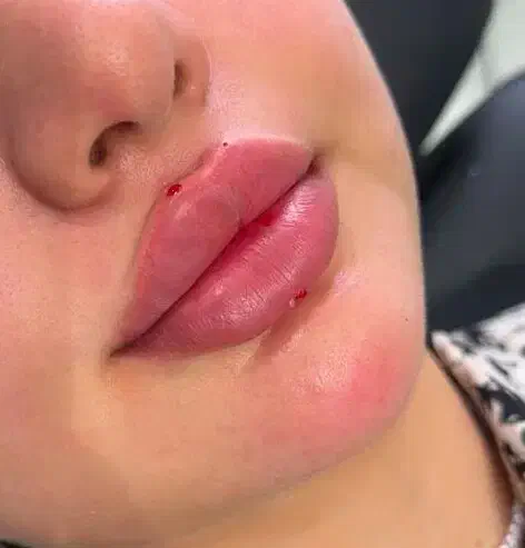 ژل و بوتاکس/ ژل لب/کانتورینگ عربی/روسی|خدمات آرایشگری و زیبایی|فردیس, فردیس|دیوار