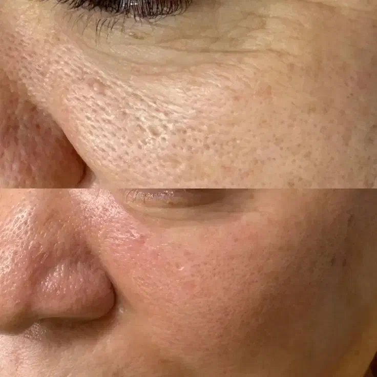 میکرونیدلینگ690 مزونیدلینگ1و300|خدمات آرایشگری و زیبایی|اهواز, نادری|دیوار