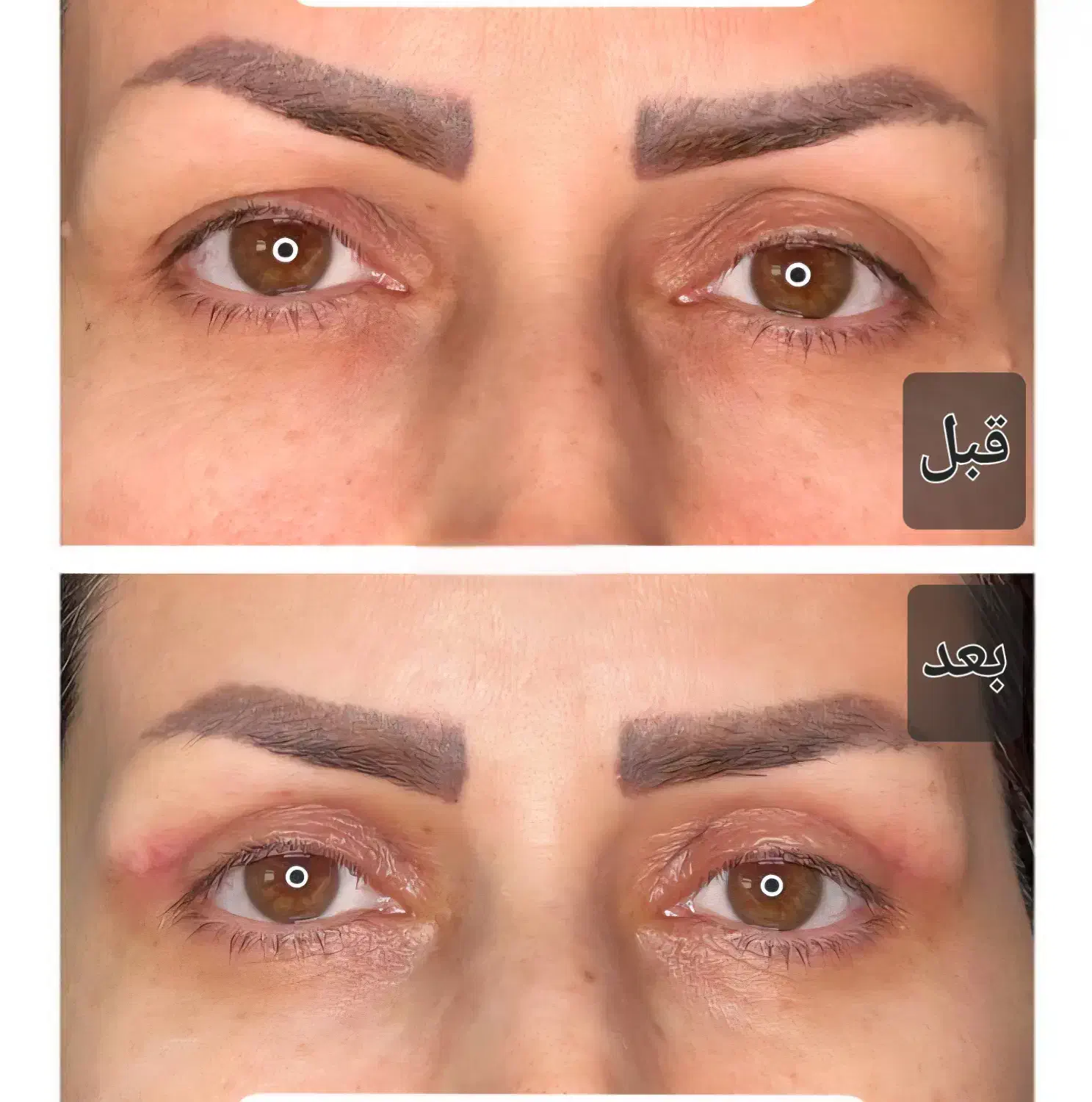 جشنواره تخفیف بلفاروپلاستی(جراحی پلک)|خدمات آرایشگری و زیبایی|شاهینشهر, فردوسی|دیوار