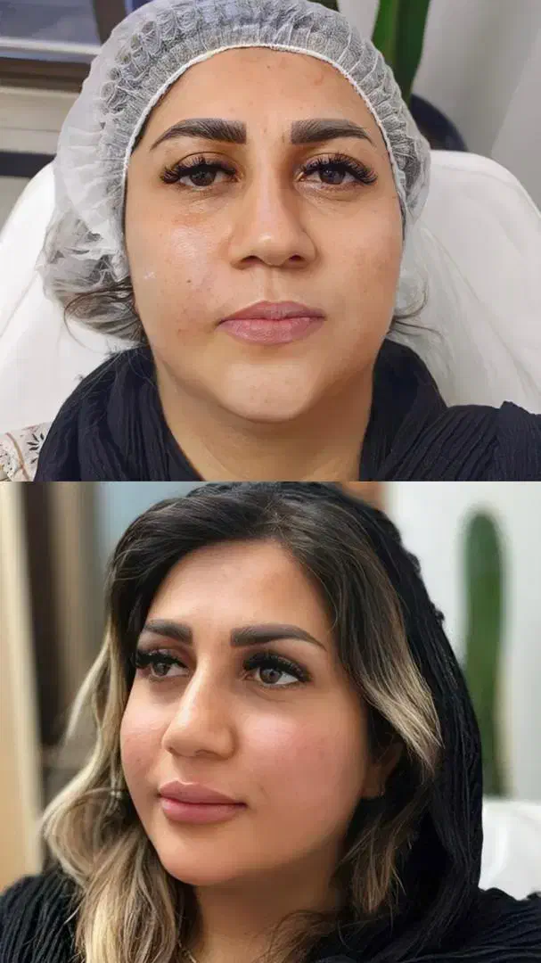 تخفیفات بلک فرایدی تزریق فیلر و بوتاکس رایگان|خدمات آرایشگری و زیبایی|ساری, |دیوار