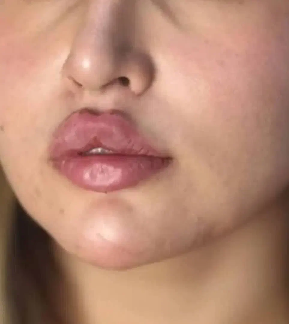 تزریق ژل و بوتاکس و کاشت نخ و مزوژل های جوان ساز|خدمات آرایشگری و زیبایی|شیراز, ابیوردی|دیوار