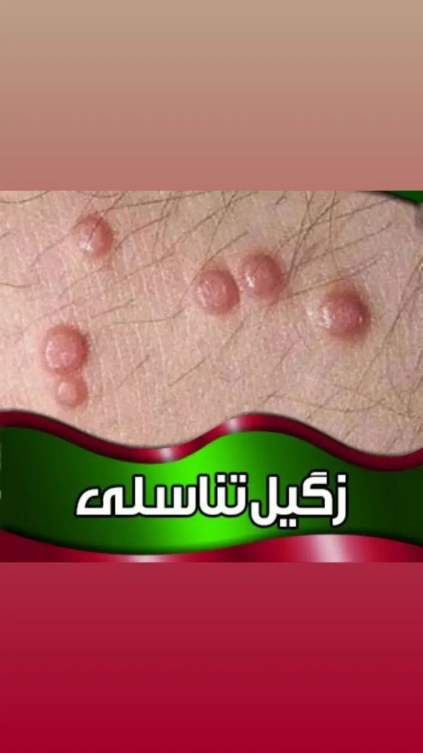 برداشتن زگیل تناسلی با قیمت پایین|خدمات آرایشگری و زیبایی|محمدیه-قزوین, |دیوار