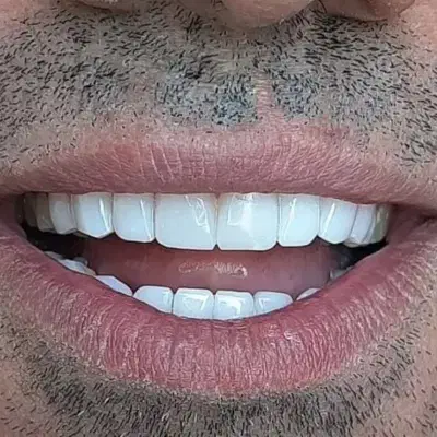 کامپوزیت دندان و تمام خدمات درمانی دندان|خدمات آرایشگری و زیبایی|اهواز, زیتون کارمندی|دیوار