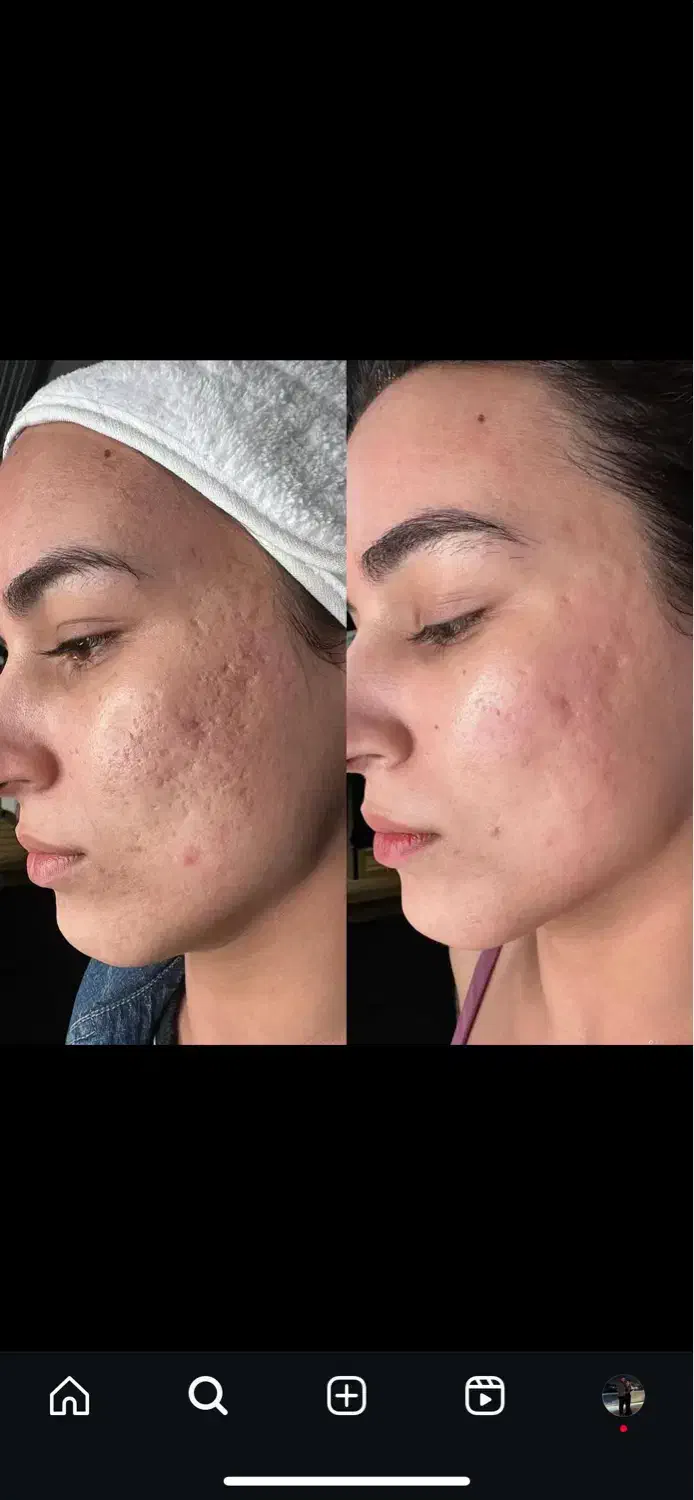 فیشال و مزونیدلینگ پوست و لیفت مژه ابرو و کاشت مژه|خدمات آرایشگری و زیبایی|تهران, تهرانپارس غربی|دیوار