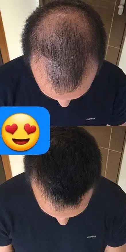 تقویت و رویش مجدد مو|آرایشی، بهداشتی، درمانی|قائن, |دیوار