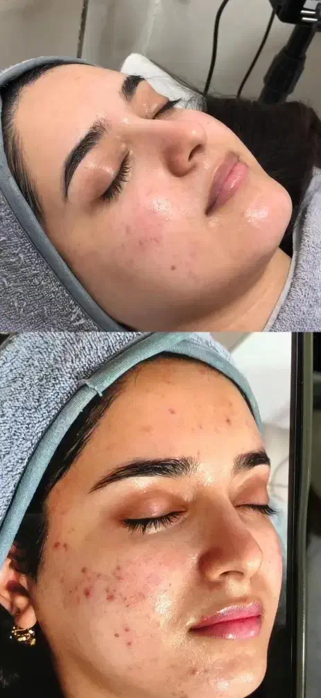 درمان جوش صورت و بدن|خدمات آرایشگری و زیبایی|دوگنبدان, |دیوار