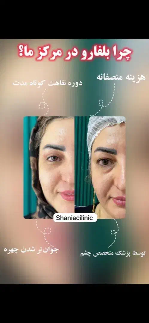 جراحی بلفاروپلاستی|خدمات آرایشگری و زیبایی|تهران, هفت حوض|دیوار