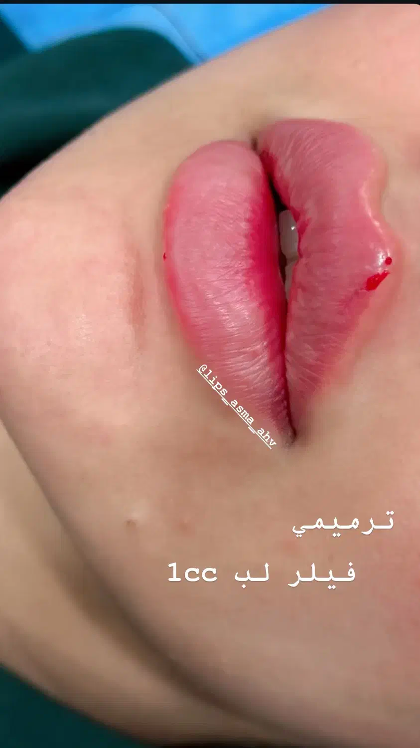 ژل وبوتاکس|خدمات آرایشگری و زیبایی|اهواز, کمپلو شمالی|دیوار