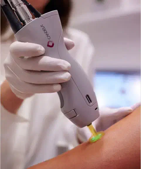 لیزر موهای زائد بدن کندلا|خدمات آرایشگری و زیبایی|میبد, |دیوار