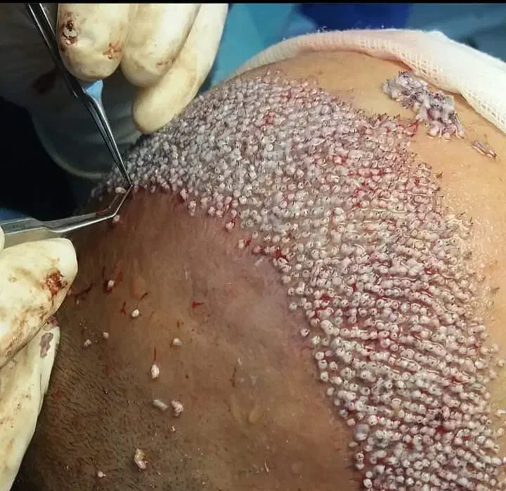 کاشت موی طبیعی -بازگشت اعتماد بنفس شما در یک جلسه|خدمات آرایشگری و زیبایی|یزد, |دیوار