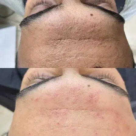 جرمگیری و پاکسازی صورت|خدمات آرایشگری و زیبایی|بم, |دیوار