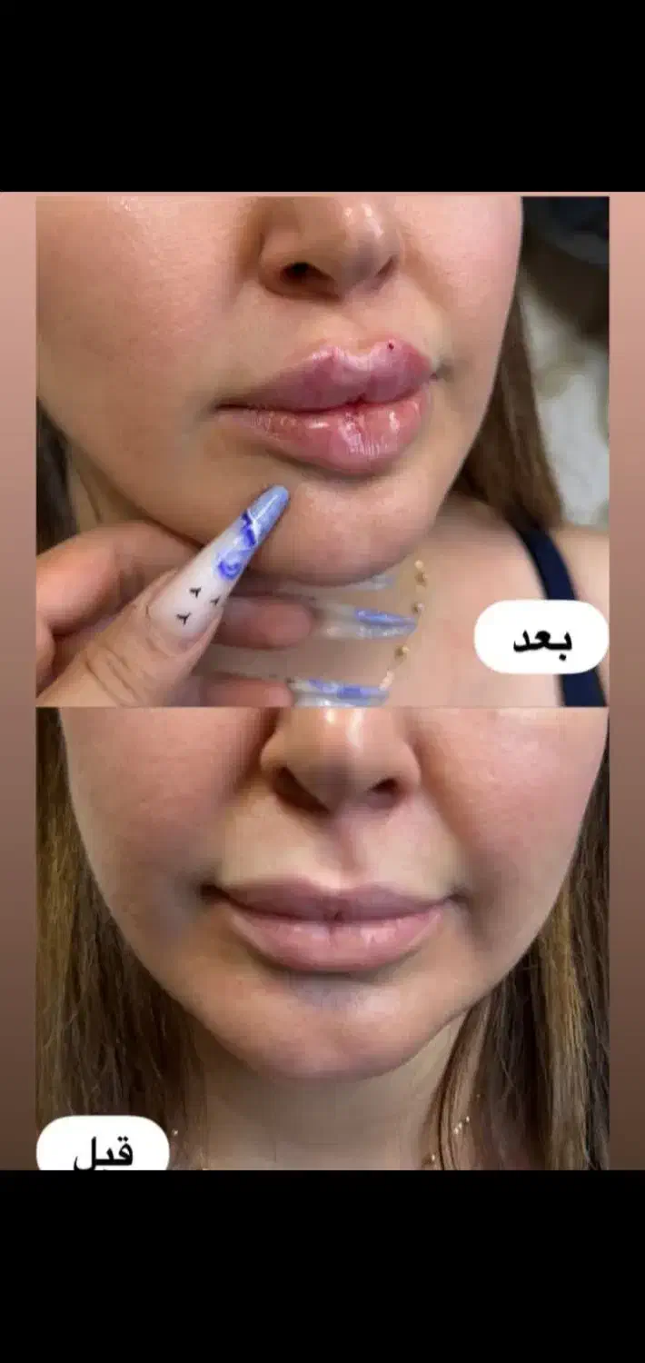 آف یلدایی ژل و بوتاکس|خدمات آرایشگری و زیبایی|دورود, |دیوار