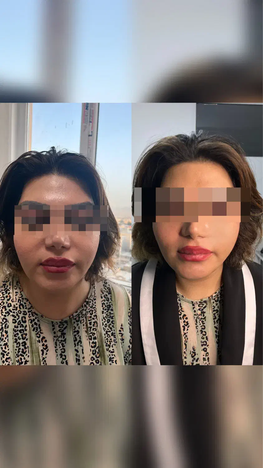 مرکزتخصصی لیفت بانخ و کانتورینگ صورت|خدمات آرایشگری و زیبایی|کرمانشاه, |دیوار