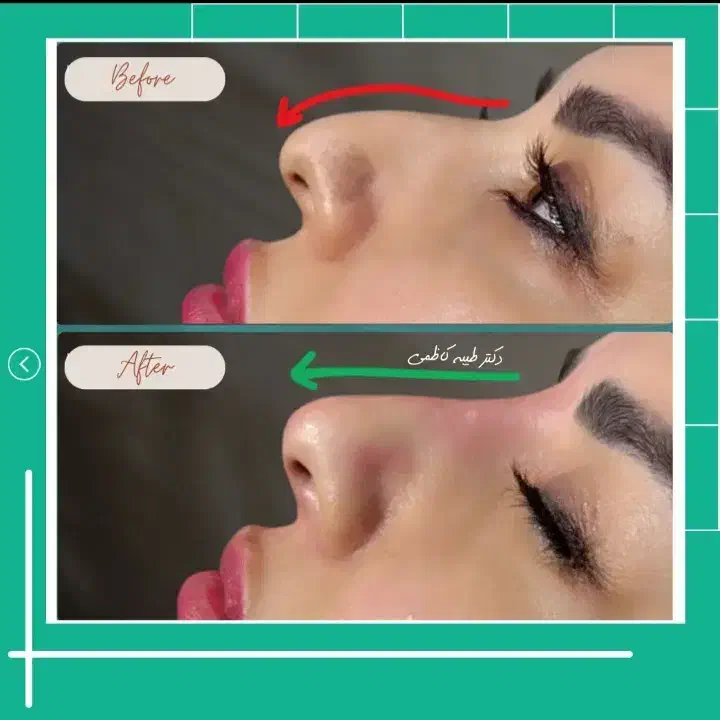 تخفیف ژل لب و بوتاکس فیلر مزو دکتر کاظمی|خدمات آرایشگری و زیبایی|مشهد, کوثر|دیوار