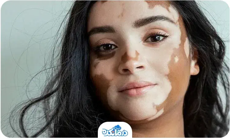 پیسی پیسوریازیس|آرایشی، بهداشتی، درمانی|قیدار, |دیوار