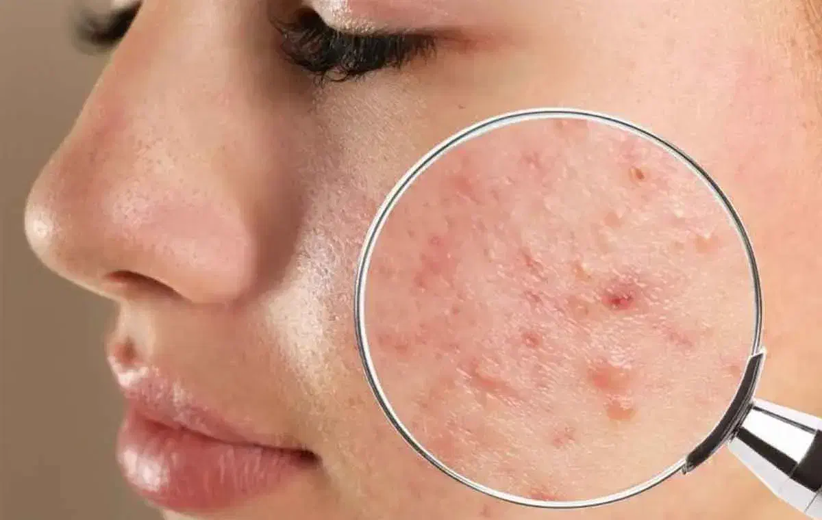 جوشهای صورت|آرایشی، بهداشتی، درمانی|شیراز, ارم|دیوار