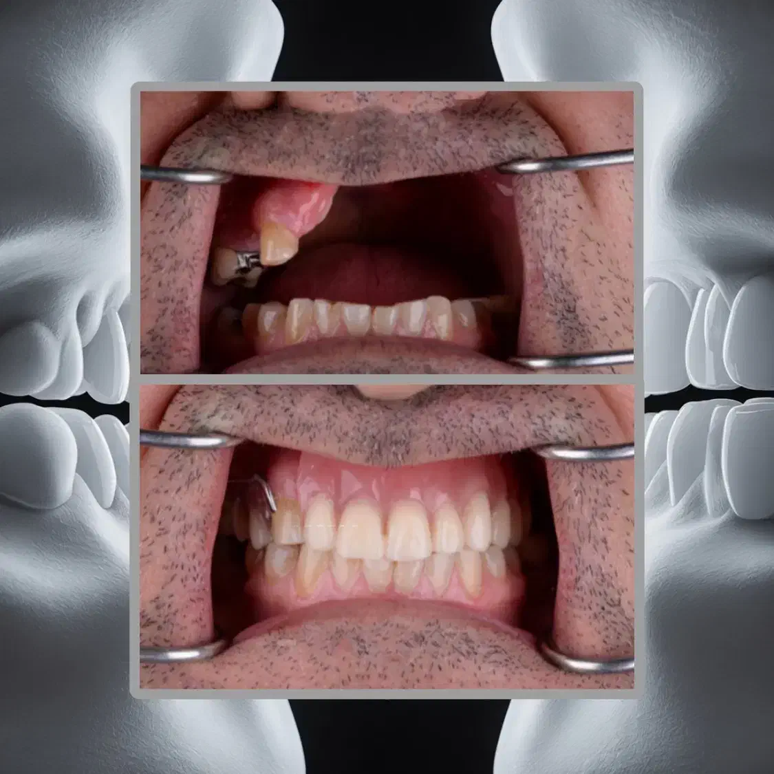 3 واحد ایمپلنت1واحد رایگان/جشنواره ایمپلنت دیجیتال|خدمات آرایشگری و زیبایی|تهران, هروی|دیوار