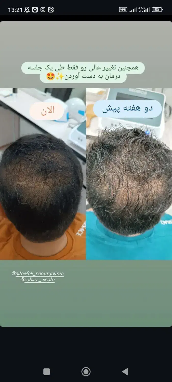 درمان ریزش مو|آرایشی، بهداشتی، درمانی|اردکان, |دیوار