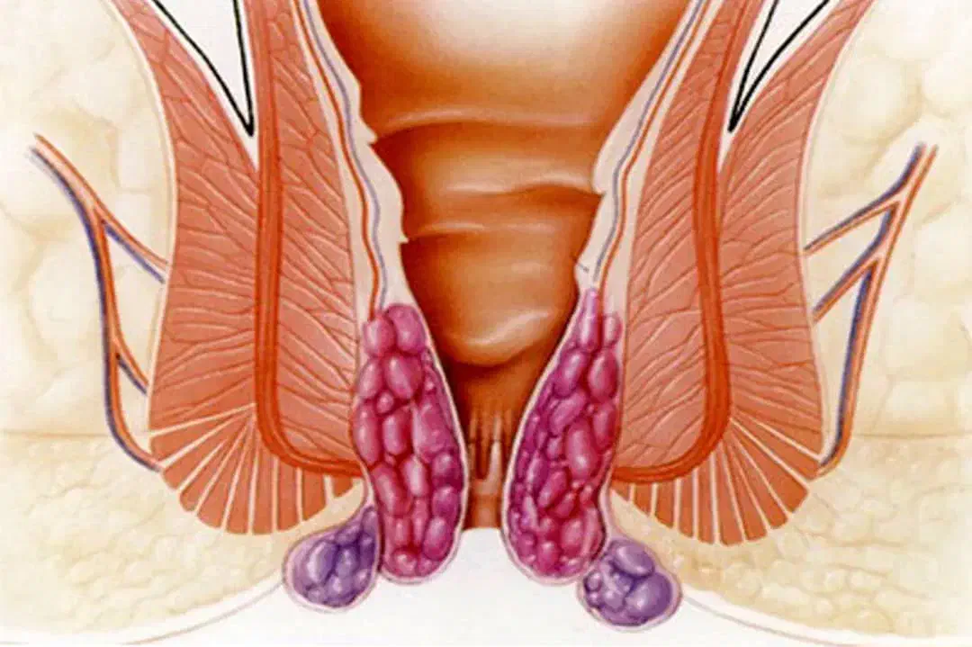 بهبودیبوست وبواسیر|خدمات آرایشگری و زیبایی|گنبد کاووس, |دیوار