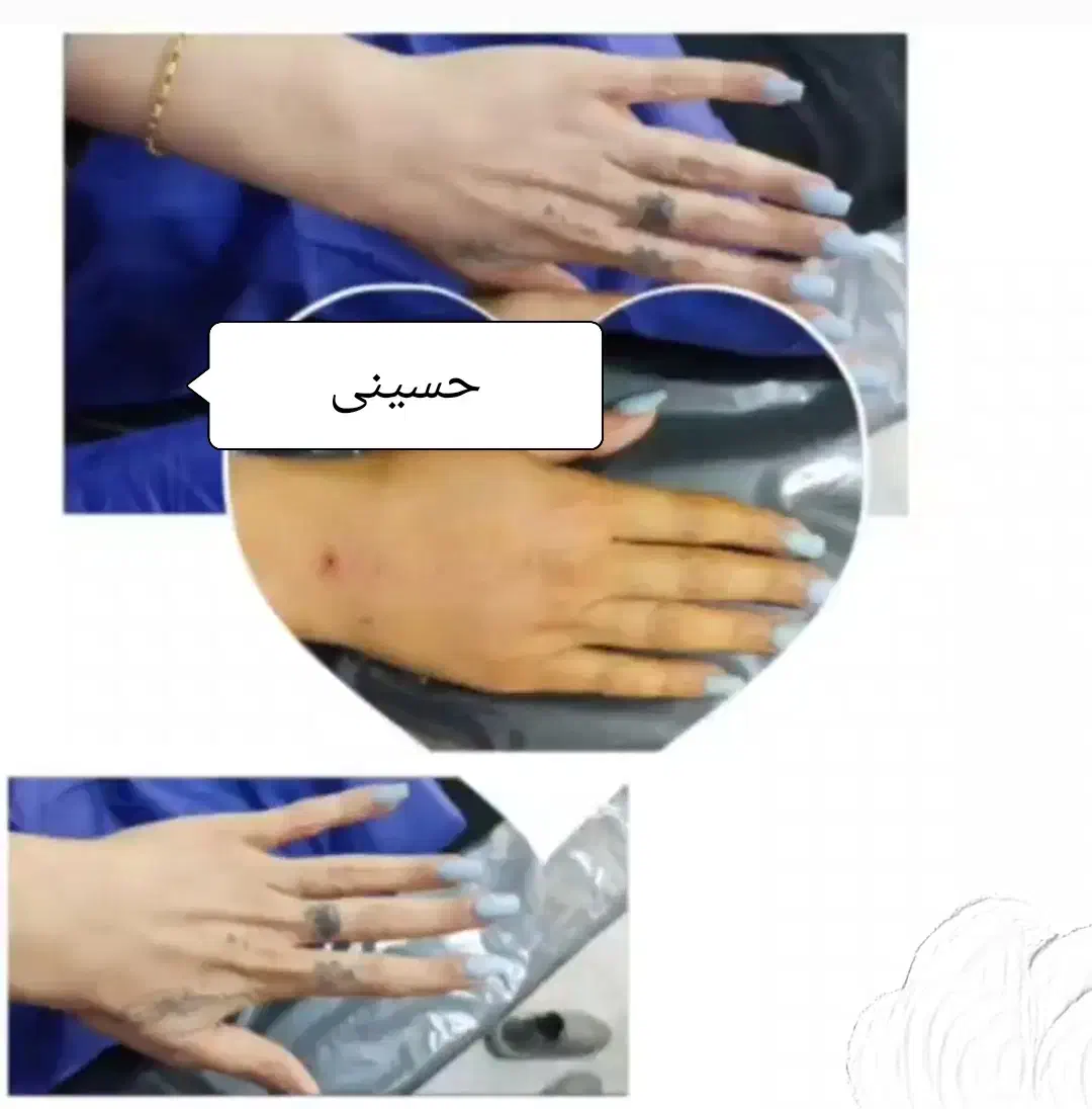 تزریق ژل چربی بوتاکس|خدمات آرایشگری و زیبایی|اهواز, کیانپارس |دیوار