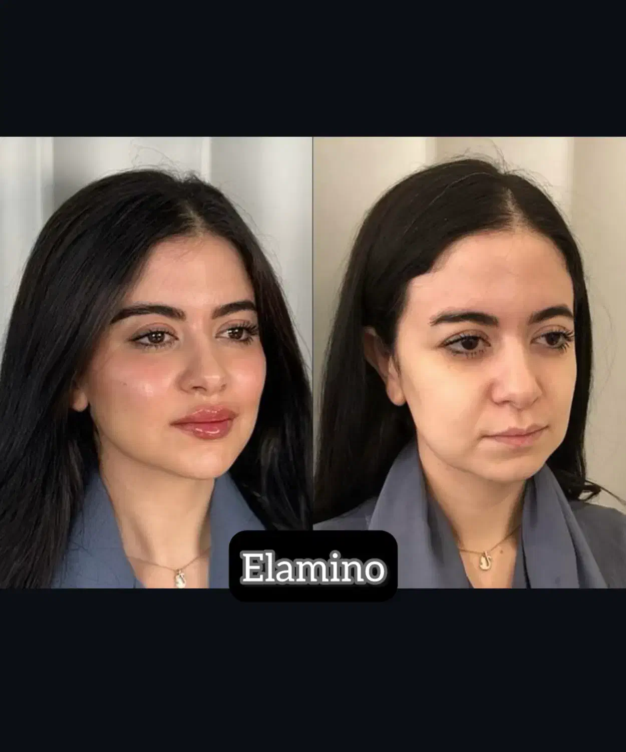 تزریق ژل بوتاکس فیلر در کلینیک زیبایی تهران|خدمات آرایشگری و زیبایی|تهران, یافت آباد جنوبی|دیوار