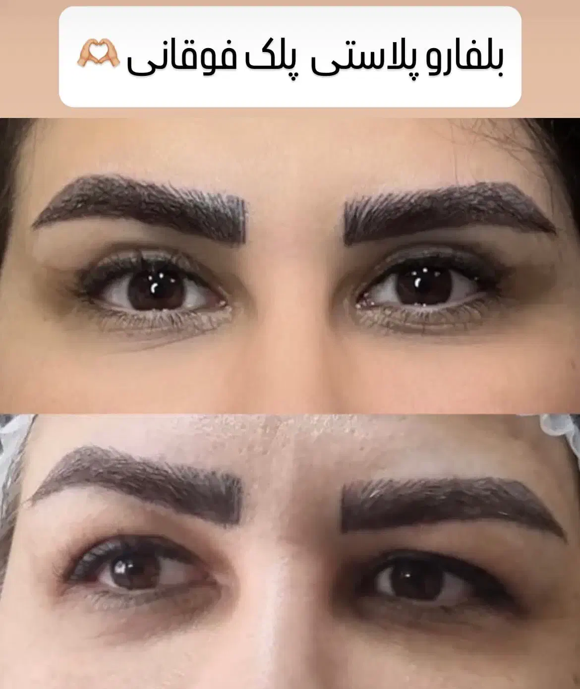 جشنواره بوتاکس و مزو به مدت محدود|خدمات آرایشگری و زیبایی|اصفهان, گلزار|دیوار