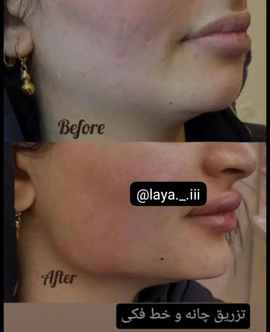 تزریقات ژل و بوتاکس|خدمات آرایشگری و زیبایی|دوگنبدان, |دیوار