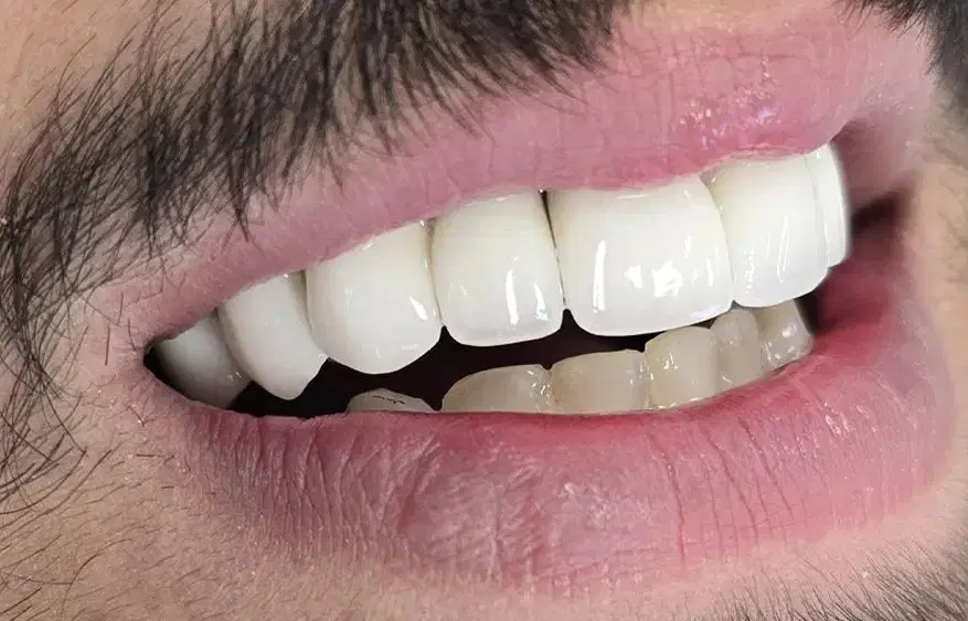 ساخت روکش دندان در دانشکده دندانپزشکی|خدمات زیبایی و سلامت|تهران, دروس|دیوار