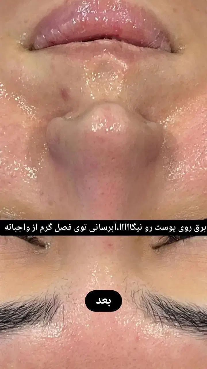 فشیال تخصصی پوست|خدمات آرایشگری و زیبایی|مرند, |دیوار