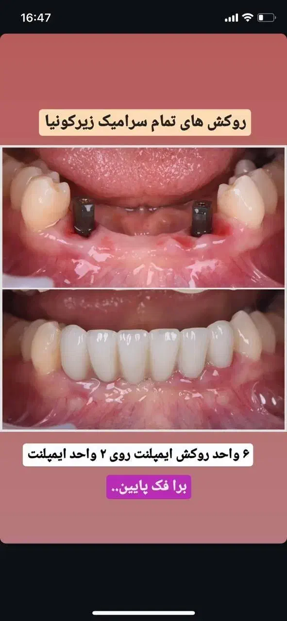 دندانپزشکی و شرایط اقساطی بدون بهره ایمپلنت|خدمات آرایشگری و زیبایی|تبریز, |دیوار