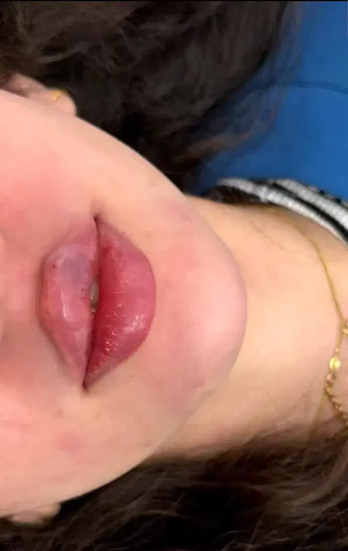 فیلر هر برندی مشتری بخواد|خدمات آرایشگری و زیبایی|یاسوج, |دیوار