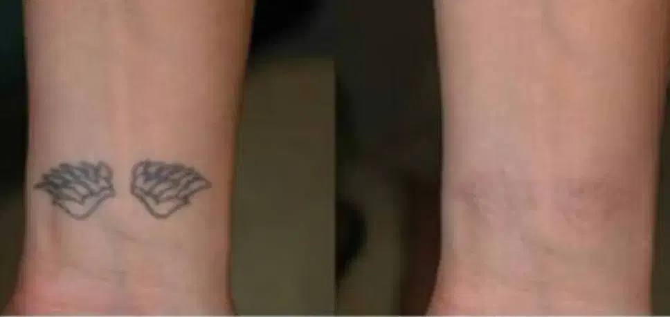 پاک کردن تاتو با پیشرفته ترین لیزر حال حاضر دنیا|خدمات آرایشگری و زیبایی|کرمانشاه, |دیوار