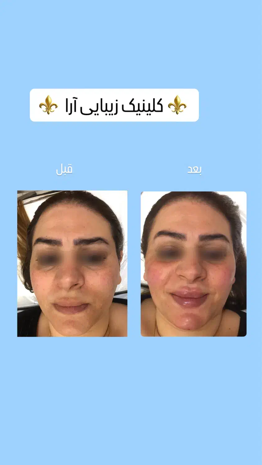 ژل/بوتاکس/مزو ژل/وآموزش|خدمات آرایشگری و زیبایی|خرمشهر, |دیوار