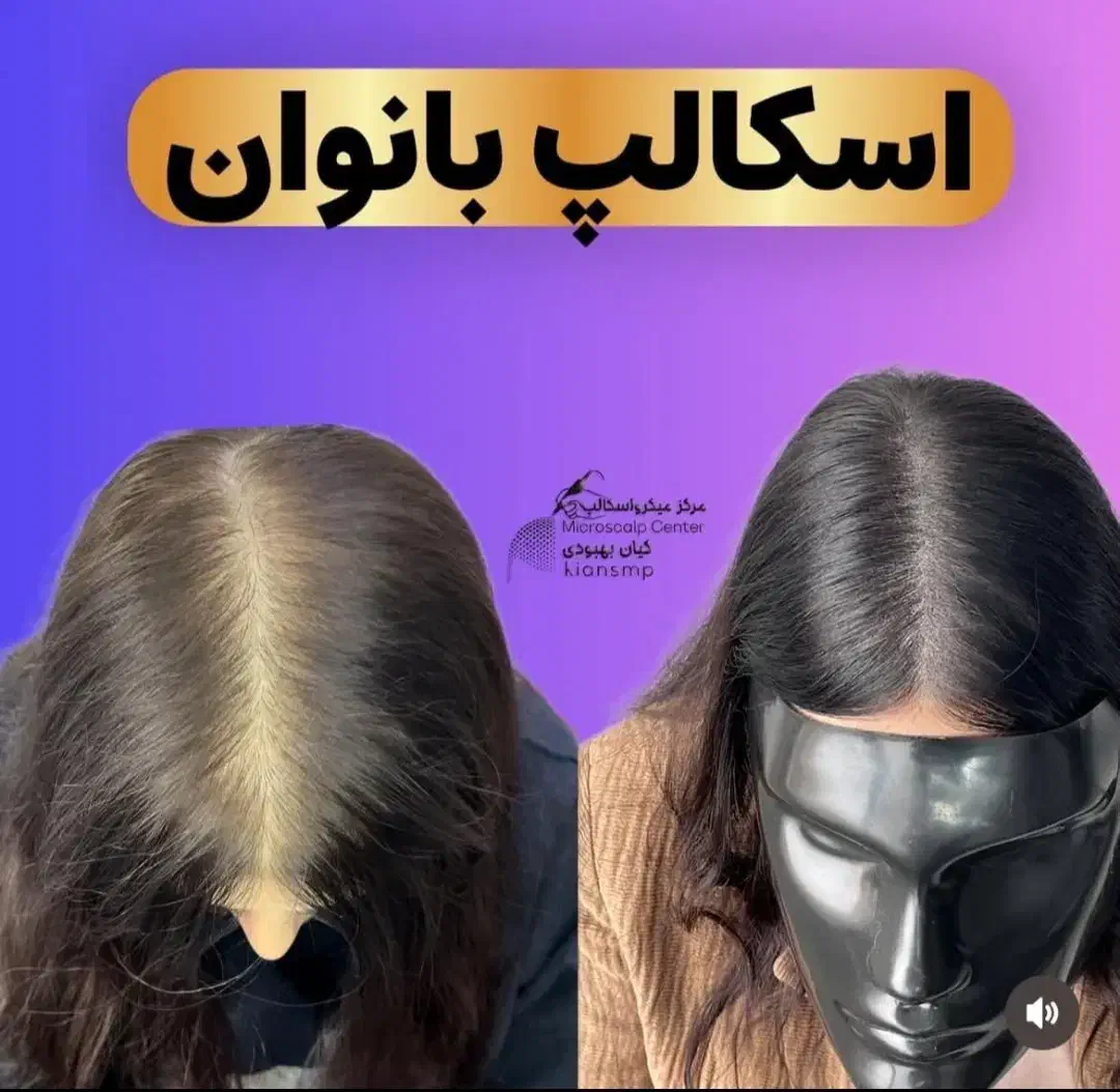 شبیه سازی فولیکول مو smp اس کالپ|خدمات آرایشگری و زیبایی|دوگنبدان, |دیوار